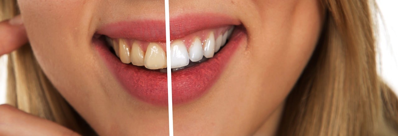Strahlend weiße Zähne: Was man über Zahnbleaching wissen sollte Strahlend weiße Zähne: Was man über Zahnbleaching wissen sollte